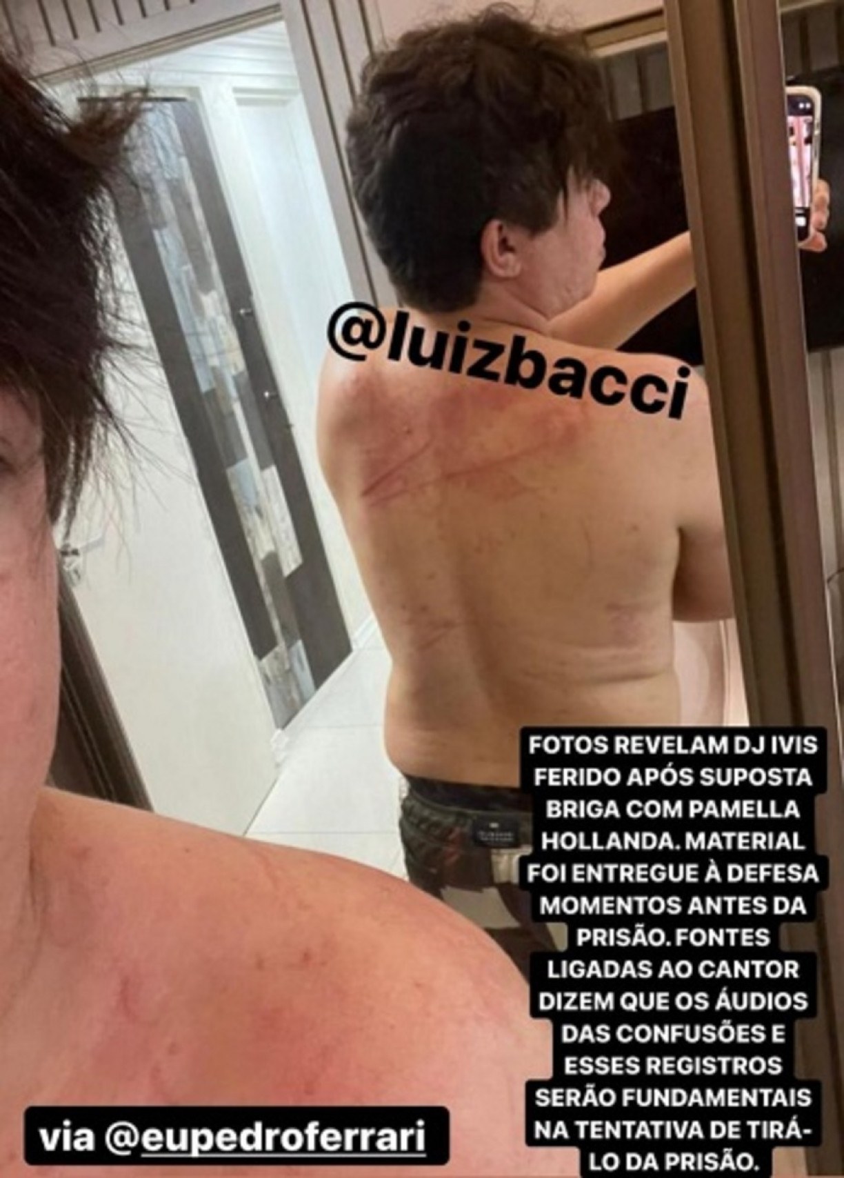 DJ Ivis com hematomas (Foto: Reprodução)