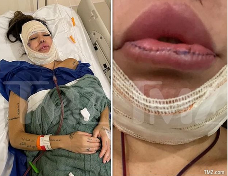 Em suma, Liziane Gutierrez tem o total de 16 cirurgia, a maioria no rosto, sendo 6 rinoplastias, harmonização facial, preenchimento labial, botox (Reprodução: Instagram)